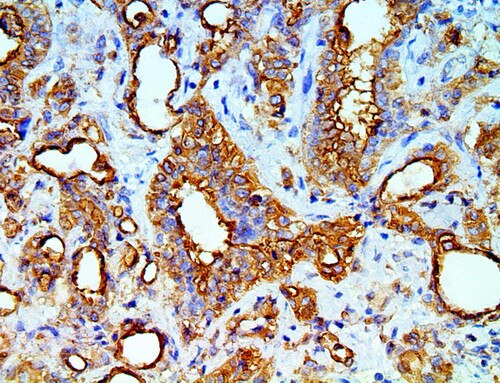 IHC of Mesothelial Cell on a FFPE Mesothelioma Tissue